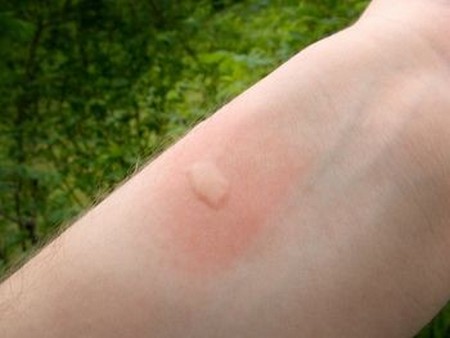 Mosquito-Bites-Itch