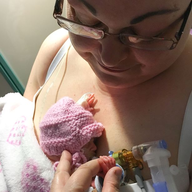 PAY-PREMATURE-MIRACLE-BABY-BORN-WITH-FEET-THE-SIZE-OF-PENNY-JUST-TWO-DAYS-AFTER-24-WEEK-ABORTION-LIMIT-1