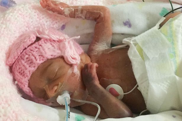 PAY-PREMATURE-MIRACLE-BABY-BORN-WITH-FEET-THE-SIZE-OF-PENNY-JUST-TWO-DAYS-AFTER-24-WEEK-ABORTION-LIMIT