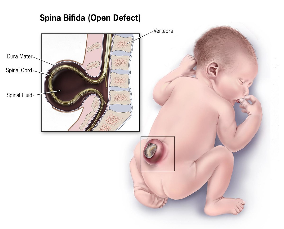 1200px-Spina-bifida