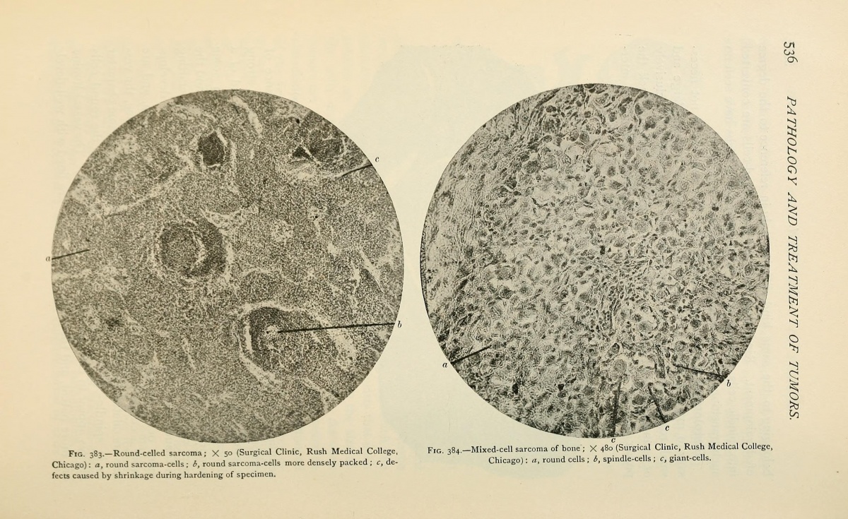 The_pathology_and_surgical_treatment_of_tumors_(1895)_(14797705823).jpg